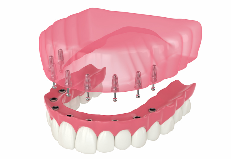 Close view of Implants Supporting Dentures in Flagstaff and Cottonwood, AZ.