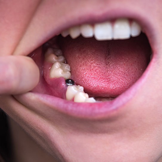 implants dentist near me