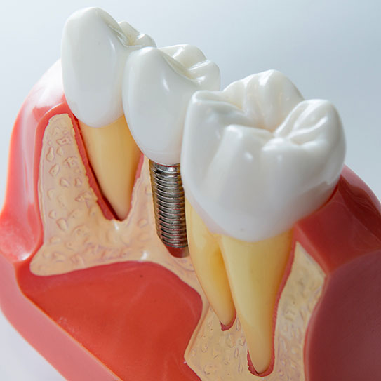 Featured image for “Dental Implants in Sedona, AZ: Restoring Your Smile with Confidence”
