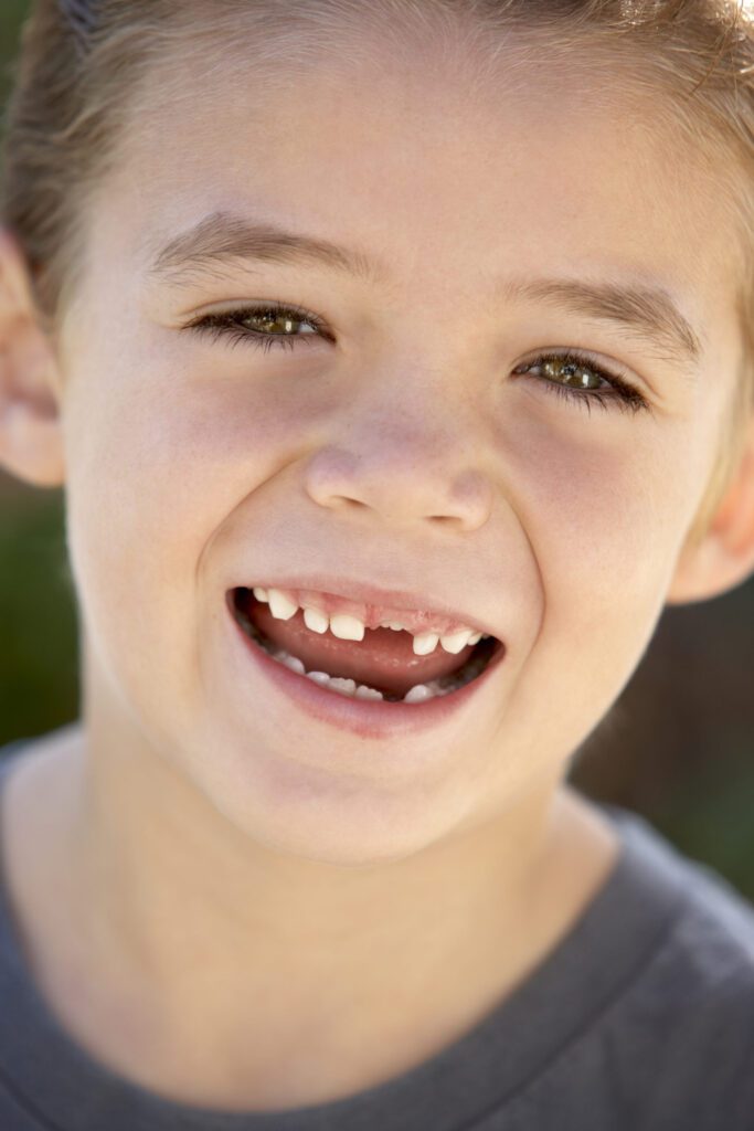 Permanent teeth erupt well after the baby teeth have fallen out