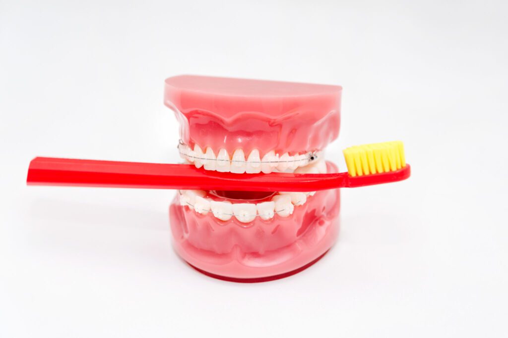 Teeth model with ceramic braces