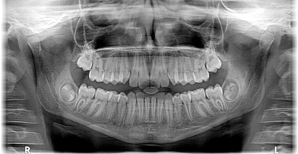 The X-ray of the person teeth at Flagstaff, AZ