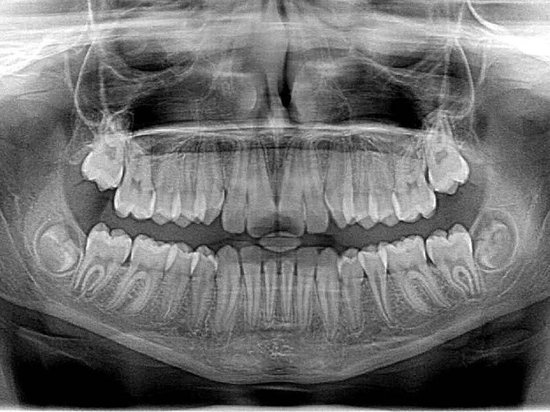 Featured image for “Understanding Dental Occlusion”
