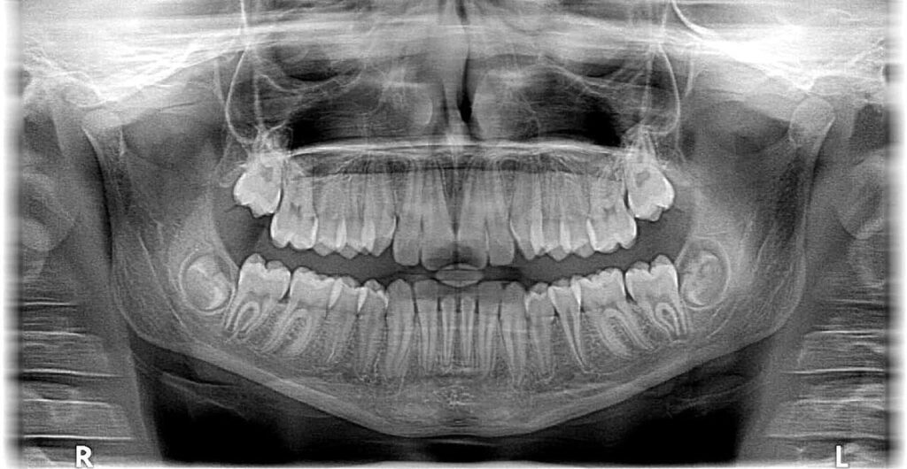 X-Ray of a persons teeth at Peak Family Dental